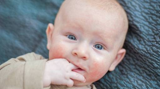 Babies-8-newborn-skin-conditions-to-look-out-for-1
