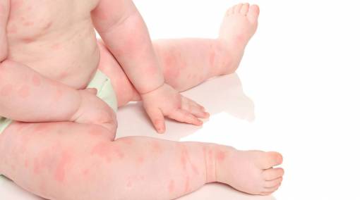 Babies--Baby-allergies-What-you-need-to-know