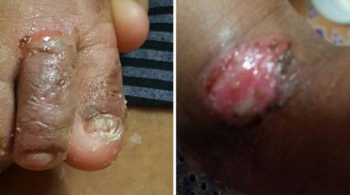 Tots--I-check-my-son’s-body-for-blisters-daily”-blisters2